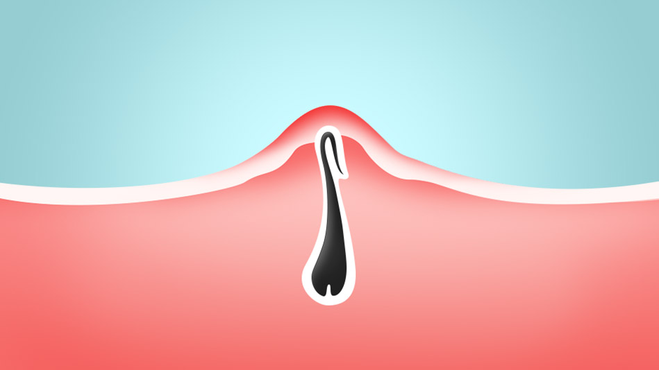 Can You Pop An Ingrown Hair With A Needle How To Get Rid Of Ingrown Hairs
