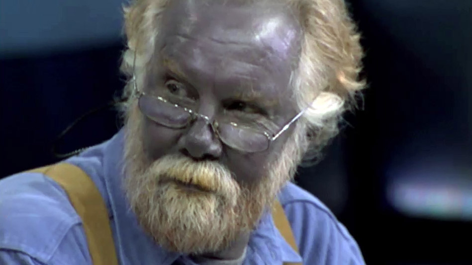 Man with completely blue skin dies at 62