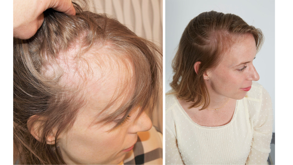 Harlinikken Hair Growth Treatment