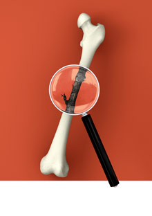 How to spot osteoporosis symptoms